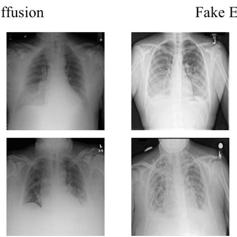 Real And Fake X Ray Images With Pleural Effusion Download Scientific Diagram