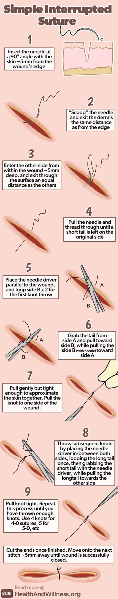 How To Suture Simple Laceration Repair Stitches Medical Medical