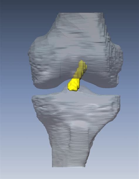 Biomotion Laboratory Acl Reconstruction