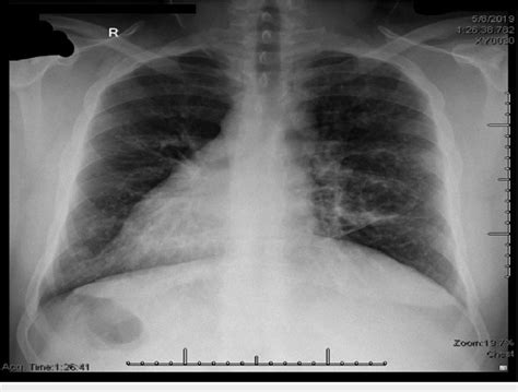Chest X Ray Showing Dextrocardia Download Scientific Diagram