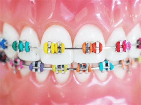 Dental Arch Finding The Perfect Colour For Your Braces