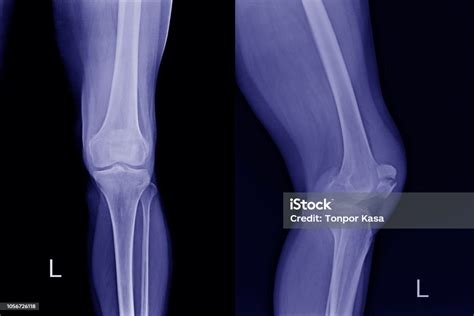xray left knee aplateral fracture kneecap a woman 65 year old color blue tone process stock