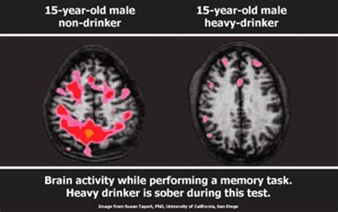 This Is What Alcohol Really Does To Your Brain