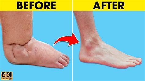 Do Your Feet Swell Watch This How To Get Rid Of Swollen Feet And