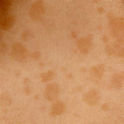 Possible causes of brown spots under the breast. Pityriasis versicolor: tinea versicolor signs, symptoms ...