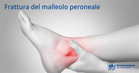 Frattura del malleolo peroneale | Riabilitazione in Campania