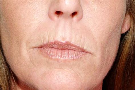 How To Get Rid Of Smokers Wrinkles How To Line Lips Mouth Wrinkles