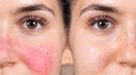 Got Rosacea Prone Skin Expert Suggests Products And Tips