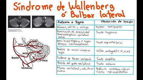 Síndrome De Wallenberg Sintomas