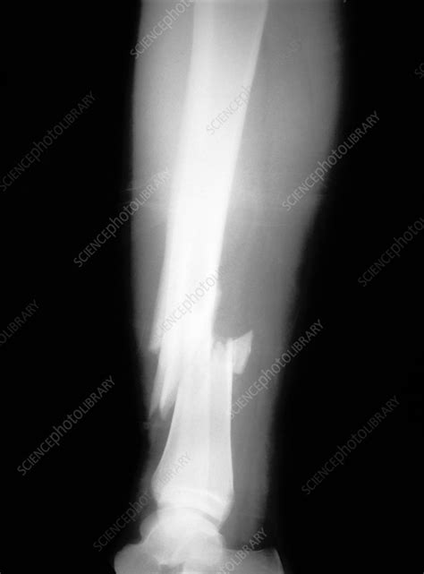 X Ray Of A Leg With A Compound Fracture Stock Image M3300774
