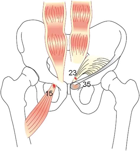 Laparoscopic Surgery For Chronic Groin Pain In Athletes Is More