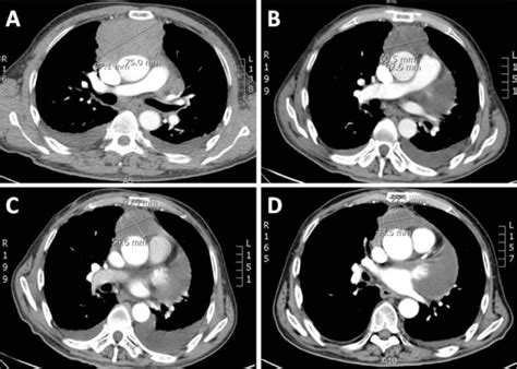 A Baseline Computed Tomography Ct Scan Of The Chest With Contrast