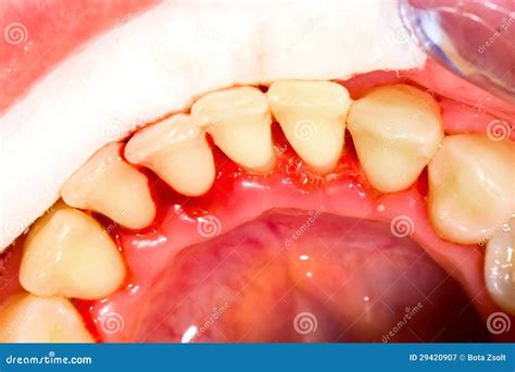 Gingivitis Stock Image Image Of Macro Clean Mouth 29420907