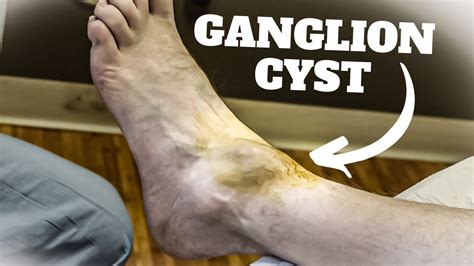 Huge Ankle Ganglion Cyst Aspiration Surgery Foot And Ankle Treatment