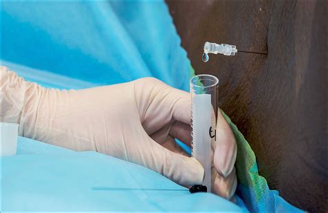 Atraumatic Lumbar Puncture Needles Practice Needs To Change The Lancet