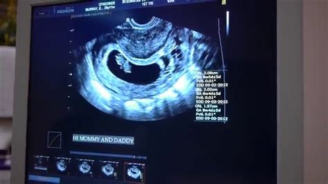 8 Week Ultrasound Heartbeat Youtube