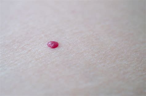 Yang memicu kehadiran bintik merah ini bisa juga dikarenakan penyakit campak. Keratosis Pilaris Bintik Merah Pada Kulit Tidak Gatal ...