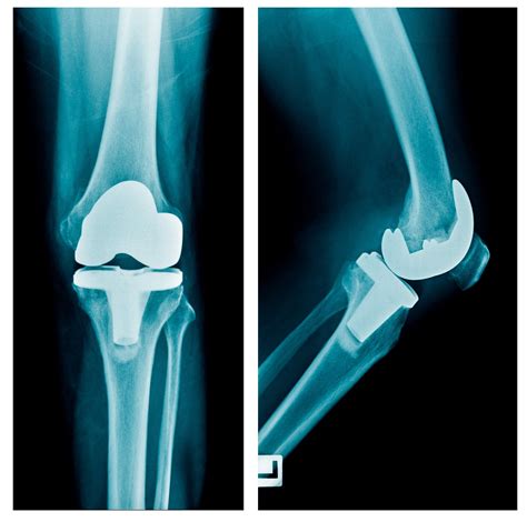 Total Knee Replacement (TKR) | Dr A. Theodorides Knee Surgeon Specialist