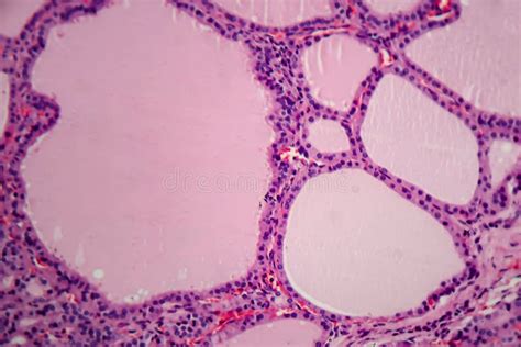 Histopathology Of Endemic Goitre Stock Photo Image Of Goitre Body