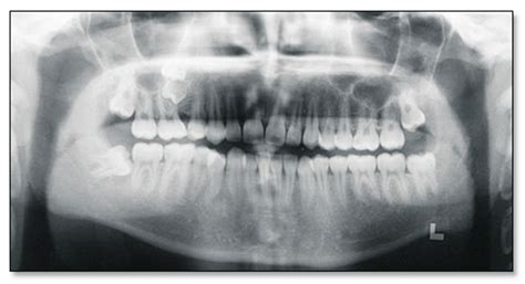 Panoramic Radiograph Showing A Totally Impacted Deciduous Maxillary