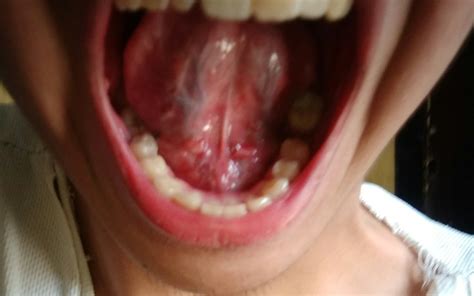 White Spot On Floor Of Mouth Under Tongue Viewfloor Co