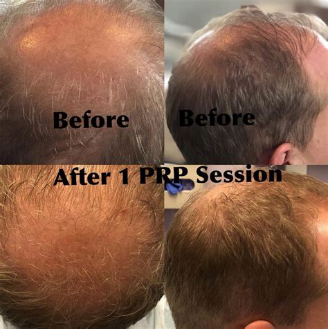 Prp Hair Restoration For Thinning Hair Hinsdale Vein And Laser