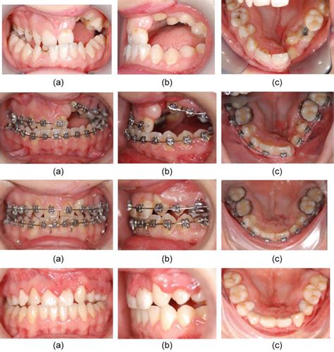 Orthognathic Surgery In Cleft Lip And Palate Patients Intechopen