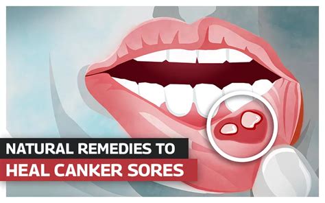 15 Home Remedies To Heal Canker Sores And Mouth Ulcers • Rodeo Dental