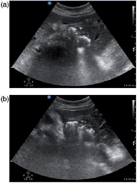 Figure 1 From Sonographic Findings Of Hepatic Venous Gas In Association