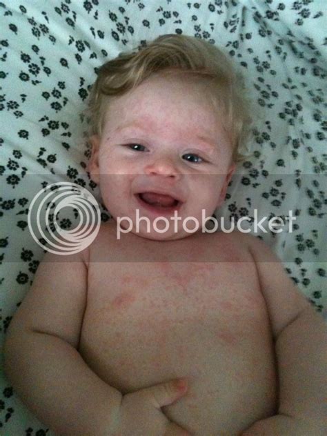 Allergic Reaction Heat Rash On Baby Belly Diaper Heat Rash Heat
