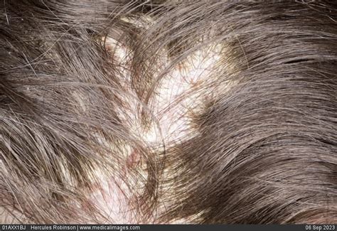 Stock Image Dermatology Scalp Psoriasis Dry White Scaly Skin With Pink