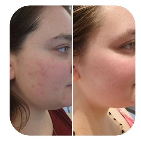 A Before And After Photo Of Our Guest After Using The Face Reality Skin