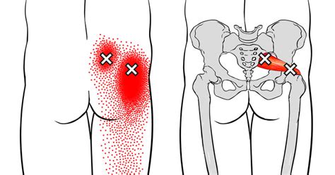 How To Address Sciatic Nerve Pain From Home Cedar Stone Spa