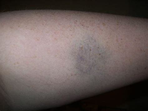 Ever Get A Bruise And Dont Know How You Did It Mylot