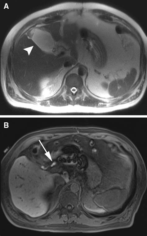 Bile Leak After Cholecystectomy A Axial T2 Haste Mri Image