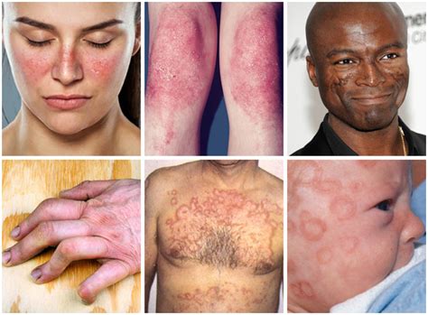 Lupus What Disease Is It And What Causes It Ecosh Life