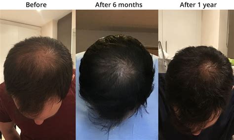 My teenage daughter was taking generic wellbutrin (manufactured by watson pharmaceuticals) 150 mg. Hair Loss Treatment For Men in London | BioGroHair ...
