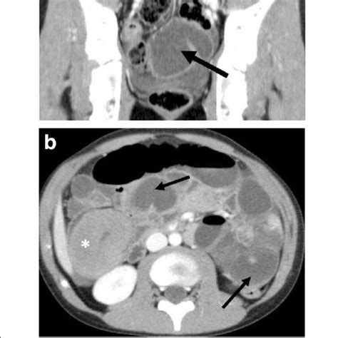 Pdf An Update On Burkitt Lymphoma A Review Of Pathogenesis And