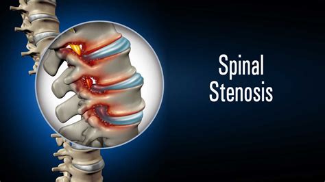 Spinal Stenosis Cervical And Lumbar Nerve Compression