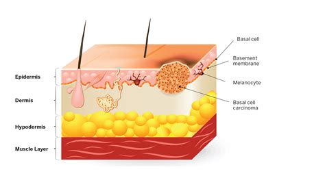 What You Need To Know About Skin Cancer D Magazine