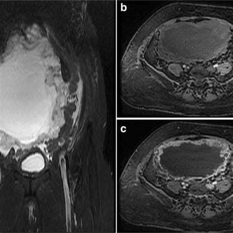 Mri Of The Abdomen Coronal T2 Weighted Fat Suppressed A And Axial