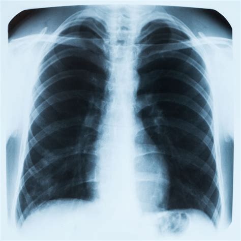 Steroid Drug Reduces Death Rate In Severe Pneumonia Study Shows