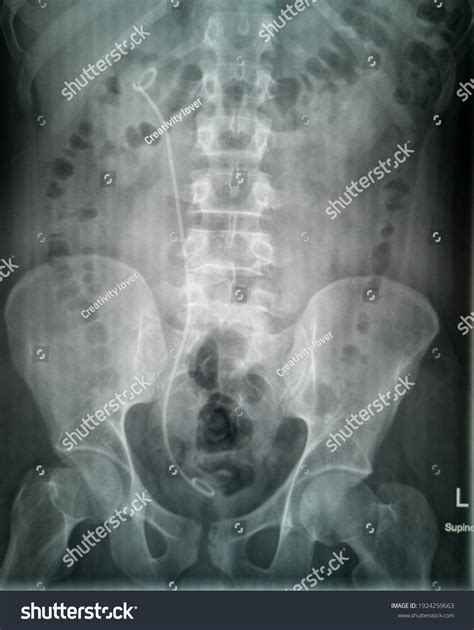 Plain Xray Urinary Tract Anteroposterior View Stock Photo 1924259663