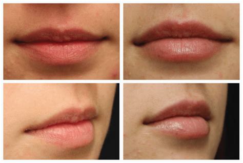 How To Get Rid Of White Spots On Lips After Filler