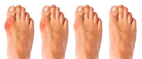 Bunion Surgery Foot Doctor Southlake Keller Flower Mound North Richland Hills And Argyle Tx