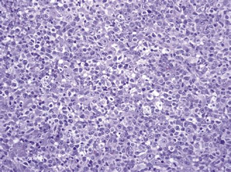 Primary Gastric Diffuse Large B Cell Lymphoma Infiltrated With