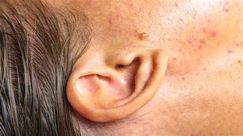 Causes And Treatment Of Lumps Behind Ear Charlies Mag