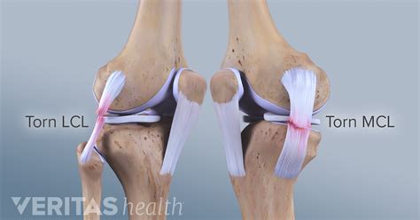 Lateral Collateral Ligament Lcl Injuries