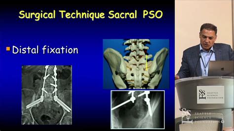 Sacral Osteotomy Techniques Khaled Kebaish Md Youtube