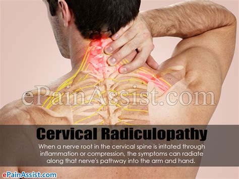 Cervical Radiculopathy Hypo Reflex Radiculopathy Cervical Images And